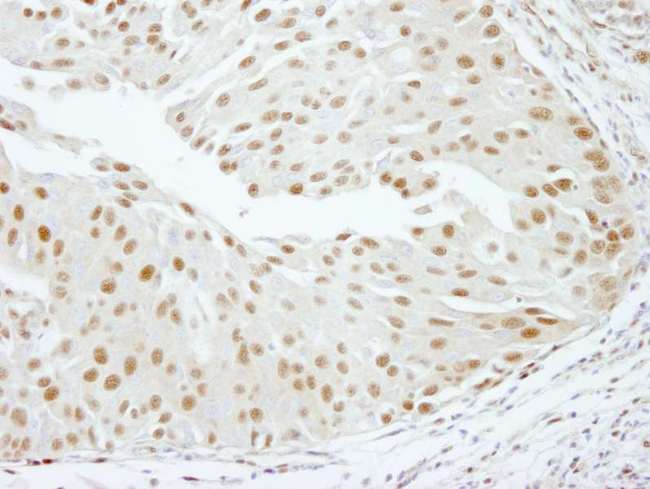 SCAF8 Antibody - Detection of Human RBM16 by Immunohistochemistry. Sample: FFPE section of human bladder carcinoma. Antibody: Affinity purified rabbit anti-RBM16 used at a dilution of 1:250.