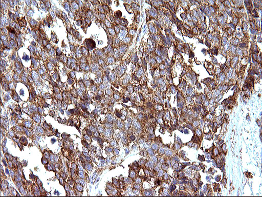 SCAMP2 Antibody - IHC of paraffin-embedded Adenocarcinoma of Human colon tissue using anti-SCAMP2 mouse monoclonal antibody. (Heat-induced epitope retrieval by 10mM citric buffer, pH6.0, 120°C for 3min).