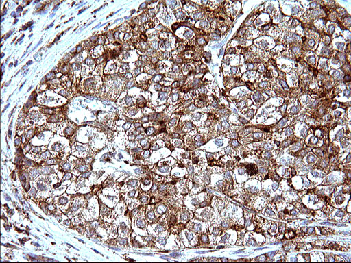 SCAMP2 Antibody - IHC of paraffin-embedded Carcinoma of Human liver tissue using anti-SCAMP2 mouse monoclonal antibody. (Heat-induced epitope retrieval by 10mM citric buffer, pH6.0, 120°C for 3min).