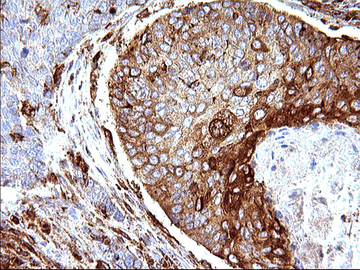 SCAMP2 Antibody - IHC of paraffin-embedded Carcinoma of Human lung tissue using anti-SCAMP2 mouse monoclonal antibody. (Heat-induced epitope retrieval by 10mM citric buffer, pH6.0, 120°C for 3min).