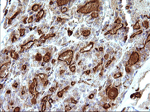 SCAMP2 Antibody - IHC of paraffin-embedded Carcinoma of Human thyroid tissue using anti-SCAMP2 mouse monoclonal antibody. (Heat-induced epitope retrieval by 10mM citric buffer, pH6.0, 120°C for 3min).