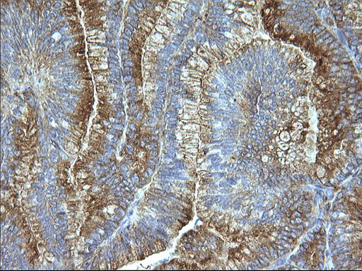 SCAMP2 Antibody - IHC of paraffin-embedded Adenocarcinoma of Human endometrium tissue using anti-SCAMP2 mouse monoclonal antibody. (Heat-induced epitope retrieval by 10mM citric buffer, pH6.0, 120°C for 3min).
