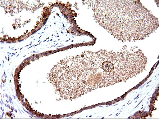 SCAMP2 Antibody - IHC of paraffin-embedded Carcinoma of Human prostate tissue using anti-SCAMP2 mouse monoclonal antibody. (Heat-induced epitope retrieval by 10mM citric buffer, pH6.0, 120°C for 3min).