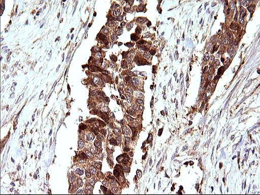SCAMP2 Antibody - IHC of paraffin-embedded Carcinoma of Human bladder tissue using anti-SCAMP2 mouse monoclonal antibody. (Heat-induced epitope retrieval by 10mM citric buffer, pH6.0, 120°C for 3min).