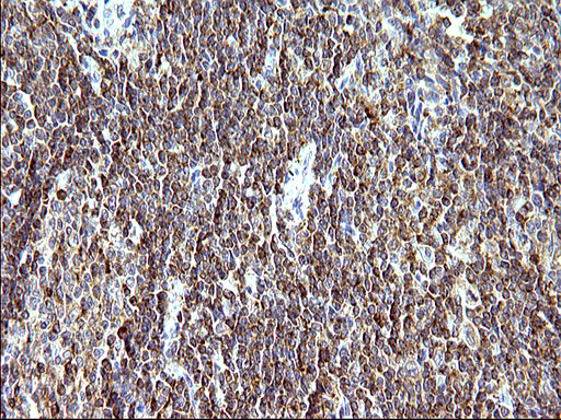SCAMP2 Antibody - IHC of paraffin-embedded Human lymphoma tissue using anti-SCAMP2 mouse monoclonal antibody. (Heat-induced epitope retrieval by 10mM citric buffer, pH6.0, 120°C for 3min).