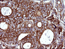 SCAMP2 Antibody - IHC of paraffin-embedded Adenocarcinoma of Human breast tissue using anti-SCAMP2 mouse monoclonal antibody. (Heat-induced epitope retrieval by 10mM citric buffer, pH6.0, 120°C for 3min).