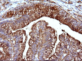 SCAMP2 Antibody - IHC of paraffin-embedded Adenocarcinoma of Human colon tissue using anti-SCAMP2 mouse monoclonal antibody. (Heat-induced epitope retrieval by 10mM citric buffer, pH6.0, 120°C for 3min).