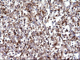 SCAMP2 Antibody - IHC of paraffin-embedded Carcinoma of Human kidney tissue using anti-SCAMP2 mouse monoclonal antibody. (Heat-induced epitope retrieval by 10mM citric buffer, pH6.0, 120°C for 3min).