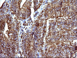 SCAMP2 Antibody - IHC of paraffin-embedded Carcinoma of Human pancreas tissue using anti-SCAMP2 mouse monoclonal antibody. (Heat-induced epitope retrieval by 10mM citric buffer, pH6.0, 120°C for 3min).