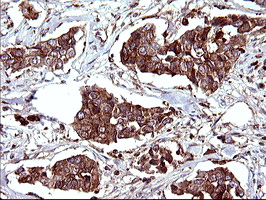 SCAMP2 Antibody - IHC of paraffin-embedded Carcinoma of Human bladder tissue using anti-SCAMP2 mouse monoclonal antibody. (Heat-induced epitope retrieval by 10mM citric buffer, pH6.0, 120°C for 3min).