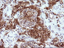 SCAMP2 Antibody - IHC of paraffin-embedded Carcinoma of Human prostate tissue using anti-SCAMP2 mouse monoclonal antibody. (Heat-induced epitope retrieval by 10mM citric buffer, pH6.0, 120°C for 3min).