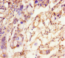 SCAMP2 Antibody - Immunohistochemistry of paraffin-embedded human pancreatic cancer using SCAMP2 Antibody at dilution of 1:100