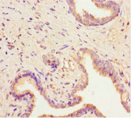 SCAMP2 Antibody - Immunohistochemistry of paraffin-embedded human prostate cancer using SCAMP2 Antibody at dilution of 1:100