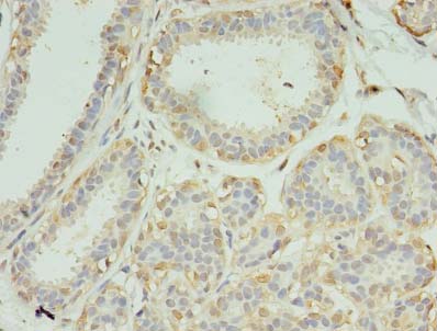 SCAMP4 Antibody - Immunohistochemistry of paraffin-embedded human breast cancer using antibody at dilution of 1:100.