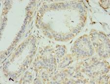 SCAMP4 Antibody - Immunohistochemistry of paraffin-embedded human breast cancer using antibody at dilution of 1:100.