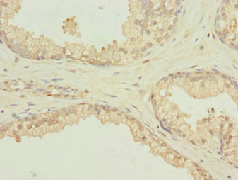 SCAND1 Antibody - Immunohistochemistry of paraffin-embedded human prostate cancer at dilution 1:100