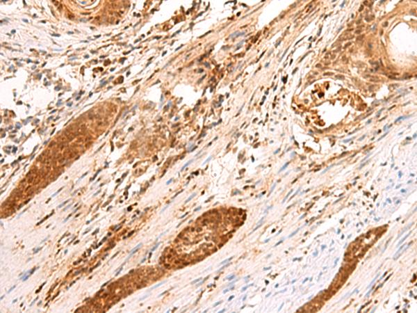 SCAND1 Antibody - Immunohistochemistry of paraffin-embedded Human esophagus cancer tissue  using SCAND1 Polyclonal Antibody at dilution of 1:90(×200)