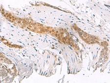 SCAND1 Antibody - Immunohistochemistry of paraffin-embedded Human esophagus cancer tissue  using SCAND1 Polyclonal Antibody at dilution of 1:50(×200)