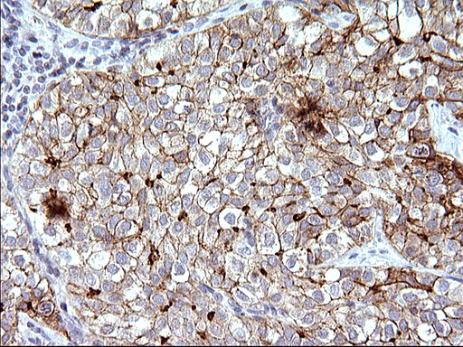 SCARB1 / SR-BI Antibody - IHC of paraffin-embedded Carcinoma of Human liver tissue using anti-SCARB1 mouse monoclonal antibody. (Heat-induced epitope retrieval by 10mM citric buffer, pH6.0, 120°C for 3min).