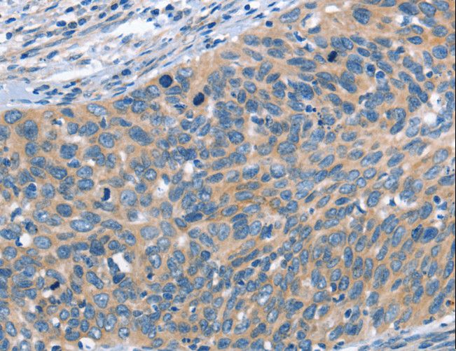 SCARB1 / SR-BI Antibody - Immunohistochemistry of paraffin-embedded Human cervical cancer using SCARB1 Polyclonal Antibody at dilution of 1:60.