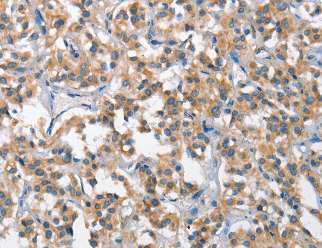 SCARB1 / SR-BI Antibody - Immunohistochemistry of paraffin-embedded Human gastric cancer using SCARB1 Polyclonal Antibody at dilution of 1:65.