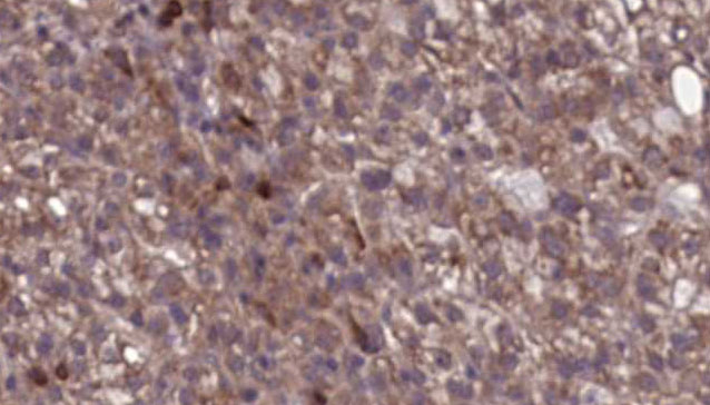 SCARB1 / SR-BI Antibody - 1:100 staining human liver carcinoma tissues by IHC-P. The sample was formaldehyde fixed and a heat mediated antigen retrieval step in citrate buffer was performed. The sample was then blocked and incubated with the antibody for 1.5 hours at 22°C. An HRP conjugated goat anti-rabbit antibody was used as the secondary.