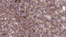 SCARB1 / SR-BI Antibody - 1:100 staining human liver carcinoma tissues by IHC-P. The sample was formaldehyde fixed and a heat mediated antigen retrieval step in citrate buffer was performed. The sample was then blocked and incubated with the antibody for 1.5 hours at 22°C. An HRP conjugated goat anti-rabbit antibody was used as the secondary.