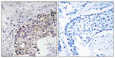 SCARF2 Antibody - Immunohistochemistry analysis of paraffin-embedded human breast carcinoma, using SCARF2 Antibody. The picture on the right is blocked with the synthesized peptide.