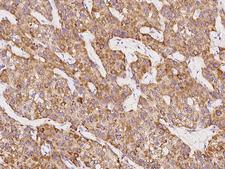 SCCPDH Antibody - Immunochemical staining of human SCCPDH in human hepatoma with rabbit polyclonal antibody at 1:100 dilution, formalin-fixed paraffin embedded sections.