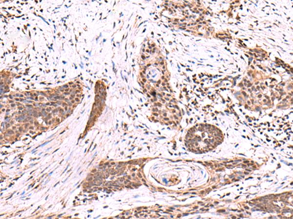 SCCPDH Antibody - Immunohistochemistry of paraffin-embedded Human esophagus cancer tissue  using SCCPDH Polyclonal Antibody at dilution of 1:85(×200)
