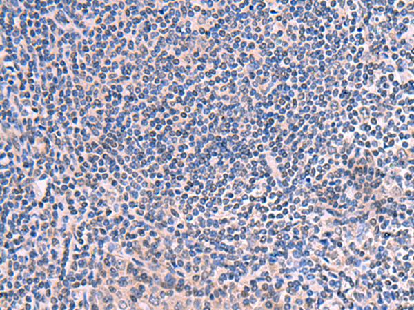 SCCPDH Antibody - Immunohistochemistry of paraffin-embedded Human tonsil tissue  using SCCPDH Polyclonal Antibody at dilution of 1:50(×200)