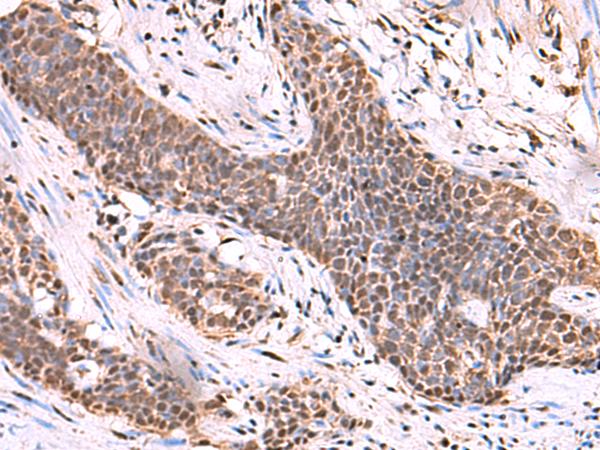 SCCPDH Antibody - Immunohistochemistry of paraffin-embedded Human esophagus cancer tissue  using SCCPDH Polyclonal Antibody at dilution of 1:50(×200)