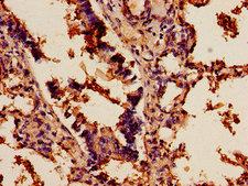 SCD1 / SCD Antibody - Immunohistochemistry of paraffin-embedded human lung cancer using SCD Antibody at dilution of 1:100