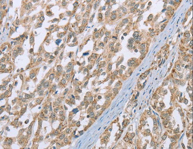 SCEH / ECHS1 Antibody - Immunohistochemistry of paraffin-embedded Human esophagus cancer using ECHS1 Polyclonal Antibody at dilution of 1:35.