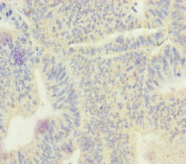 SCEH / ECHS1 Antibody - Immunohistochemistry of paraffin-embedded human colon cancer at dilution of 1:100