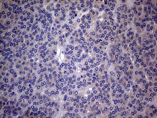 SCFD1 / SLY1 Antibody - Immunohistochemical staining of paraffin-embedded Carcinoma of Human thyroid tissue using anti-SCFD1 mouse monoclonal antibody. (Heat-induced epitope retrieval by 1mM EDTA in 10mM Tris buffer. (pH8.5) at 120°C for 3 min. (1:2000)