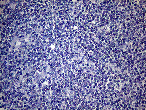 SCFD1 / SLY1 Antibody - Immunohistochemical staining of paraffin-embedded Human lymphoma tissue using anti-SCFD1 mouse monoclonal antibody.This figure shows negative staining. (Heat-induced epitope retrieval by 1mM EDTA in 10mM Tris buffer. (pH8.5) at 120°C for 3 min. (1:2000)