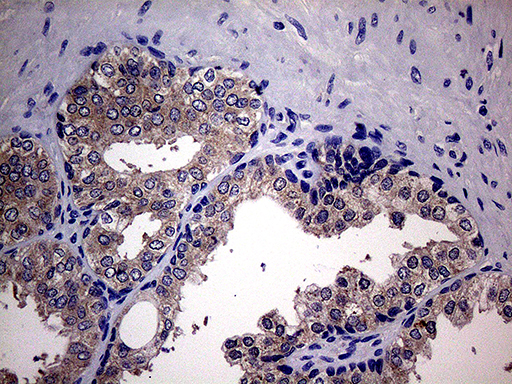 SCFD1 / SLY1 Antibody - Immunohistochemical staining of paraffin-embedded Carcinoma of Human prostate tissue using anti-SCFD1 mouse monoclonal antibody. (Heat-induced epitope retrieval by 1mM EDTA in 10mM Tris buffer. (pH8.5) at 120°C for 3 min. (1:2000)