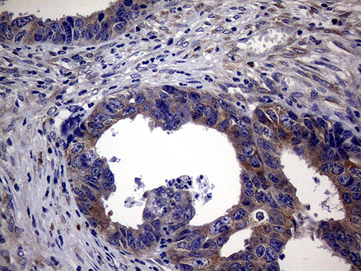 SCFD1 / SLY1 Antibody - Immunohistochemical staining of paraffin-embedded Adenocarcinoma of Human colon tissue using anti-SCFD1 mouse monoclonal antibody. (Heat-induced epitope retrieval by 1mM EDTA in 10mM Tris buffer. (pH8.5) at 120°C for 3 min. (1:2000)