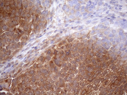 SCFD1 / SLY1 Antibody - Immunohistochemical staining of paraffin-embedded Adenocarcinoma of Human ovary tissue using anti-SCFD1 mouse monoclonal antibody. (Heat-induced epitope retrieval by 1mM EDTA in 10mM Tris buffer. (pH8.5) at 120 oC for 3 min. (1:150)