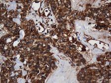 SCFD1 / SLY1 Antibody - IHC of paraffin-embedded Carcinoma of Human pancreas tissue using anti-SCFD1 mouse monoclonal antibody. (Heat-induced epitope retrieval by 10mM citric buffer, pH6.0, 120°C for 3min).