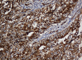 SCFD1 / SLY1 Antibody - IHC of paraffin-embedded Adenocarcinoma of Human endometrium tissue using anti-SCFD1 mouse monoclonal antibody. (Heat-induced epitope retrieval by 10mM citric buffer, pH6.0, 120°C for 3min).