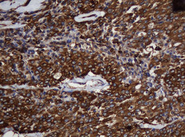 SCFD1 / SLY1 Antibody - IHC of paraffin-embedded Carcinoma of Human thyroid tissue using anti-SCFD1 mouse monoclonal antibody. (Heat-induced epitope retrieval by 10mM citric buffer, pH6.0, 120°C for 3min).