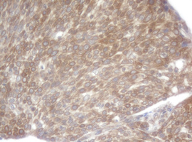 SCFD1 / SLY1 Antibody - IHC of paraffin-embedded Carcinoma of Human bladder tissue using anti-SCFD1 mouse monoclonal antibody. (Heat-induced epitope retrieval by 10mM citric buffer, pH6.0, 120°C for 3min).