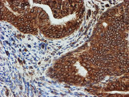 SCFD1 / SLY1 Antibody - IHC of paraffin-embedded Adenocarcinoma of Human endometrium tissue using anti-SCFD1 mouse monoclonal antibody.