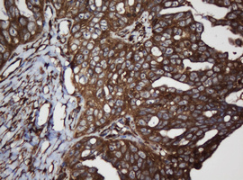 SCFD1 / SLY1 Antibody - IHC of paraffin-embedded Adenocarcinoma of Human ovary tissue using anti-SCFD1 mouse monoclonal antibody.