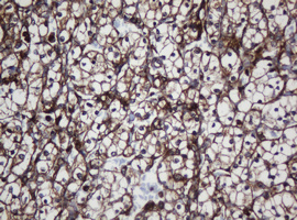 SCFD1 / SLY1 Antibody - IHC of paraffin-embedded Carcinoma of Human kidney tissue using anti-SCFD1 mouse monoclonal antibody.