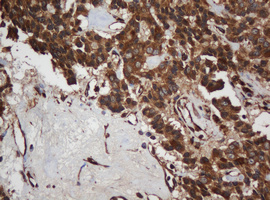SCFD1 / SLY1 Antibody - IHC of paraffin-embedded Carcinoma of Human pancreas tissue using anti-SCFD1 mouse monoclonal antibody.