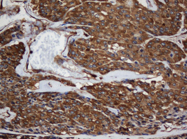 SCFD1 / SLY1 Antibody - IHC of paraffin-embedded Carcinoma of Human thyroid tissue using anti-SCFD1 mouse monoclonal antibody.