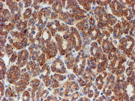 SCFD1 / SLY1 Antibody - IHC of paraffin-embedded Carcinoma of Human thyroid tissue using anti-SCFD1 mouse monoclonal antibody.